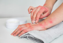 Psoriaas Psoriaas