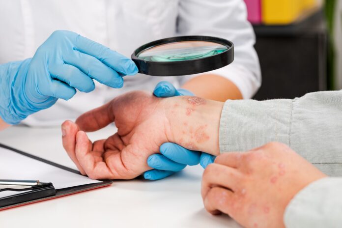 psoriaas