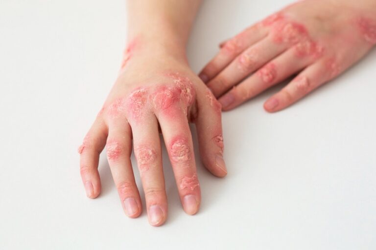psoriaatiline artriit